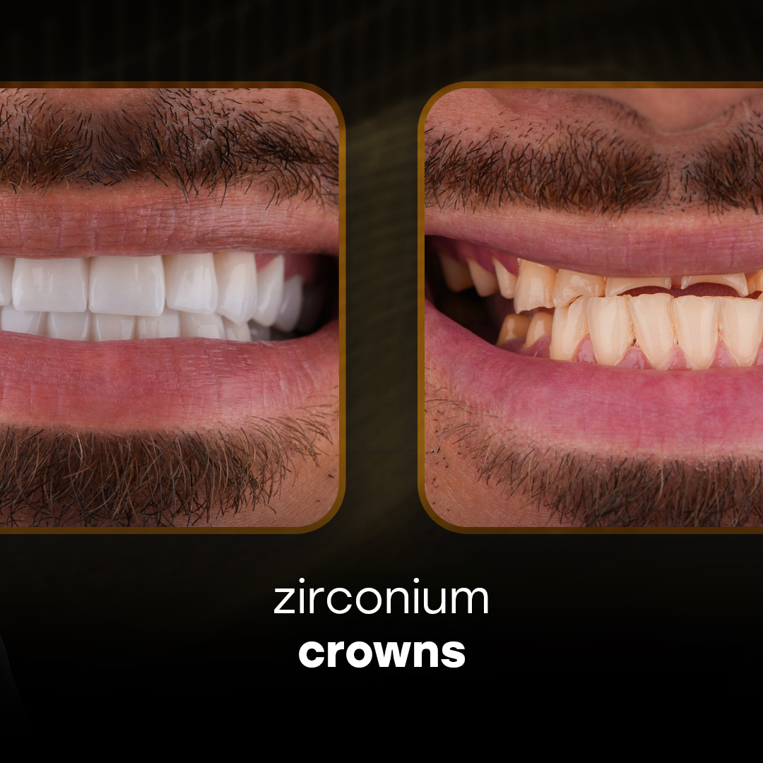 Zircon Crowns Patient